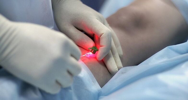 Barizeen tratamendu kirurgikoa