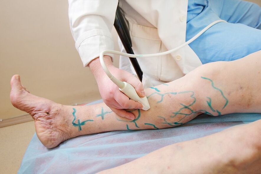 Miniphlebectomy prestatzea - ​​hankaren zulatzaileak markatzea, ekografia bat egitea